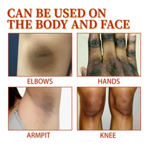 Spray Acanthosis Nigricans per corpo e viso, cura sbiancante per gomiti, mani e ginocchia.