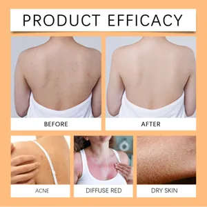 Product efficacy chart showing before and after results for acne, red skin, and dry body skin.