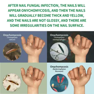 Infographic ter illustratie van schimmelnagelinfectiesymptomen, dikte en veel voorkomende schimmels.