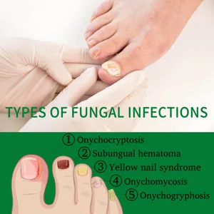 Gedetailleerd overzicht met typen schimmelinfecties en professionele nagelverzorgingsgids.