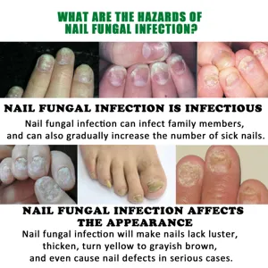Vloeistof voor nagelschimmelverzorging met symptomen en gezondheidsrisico's in detail.