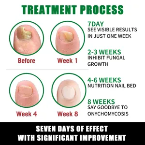 Nagelverzorgingsvloeistof behandelingsproces met voor en na resultaten voor gezonde nagels.