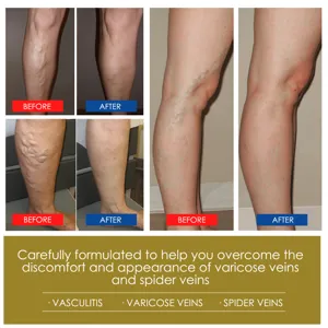 Varicose veins and spider veins treatment before and after comparison photo details.