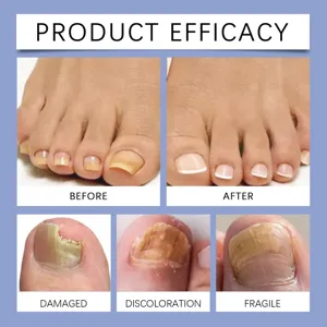 XIMONTH nail care patch detail image showing product efficacy before and after treatment.