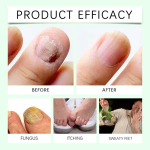 Ximonth nail care liquid for fungal nails, repair and treatment of thick toenails care.