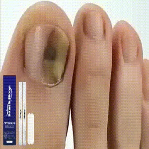 Nahaufnahme des Zehennagel-Korrekturwerkzeugs und Patch-Kits für effektive Nagelpflege.