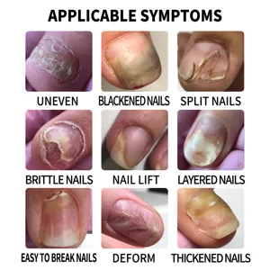 Nagelverzorging roller symptoomgids voor ongelijke gespleten en broze nagels behandeling.