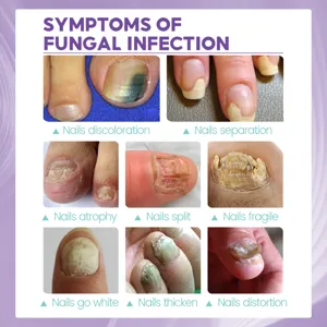 Nail care spray symptom infographic chart for fungal infection and discolored nails repair.