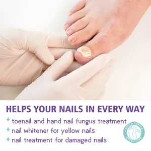 Nail repair treatment spray for damaged and yellow toenails, antifungal care and whitening.