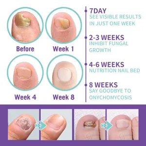 Nail care treatment spray result chart showing before and after 8 weeks fungal nail repair.