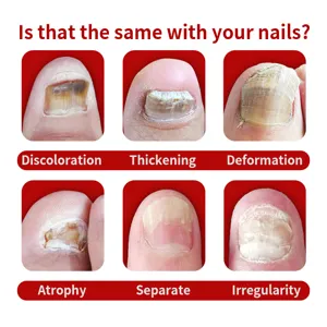 Nail care product detail showing common nail issues like discoloration and thickening symptoms.
