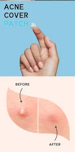 Cerotti anti-acne invisibili per un trattamento efficace, cerotti idrocolloidali traspiranti.