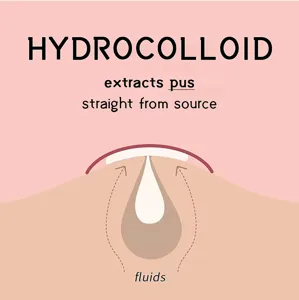 Vista dettagliata del cerotto idrocolloide per acne che mostra come estrae pus e liquidi puri.
