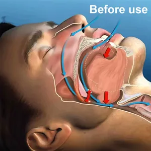 Anatomical diagram illustrating mouth breathing and airway status before using anti-snoring tape.