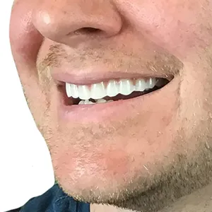 Close-up detail shot of cosmetic silicone teeth veneers worn on mouth for bright smile effect.