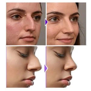 Effective nose bridge shaping before and after comparison showing contouring results