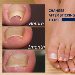 Parche corrector de uña encarnada, herramienta de cuidado de uñas de los pies muy eficaz.