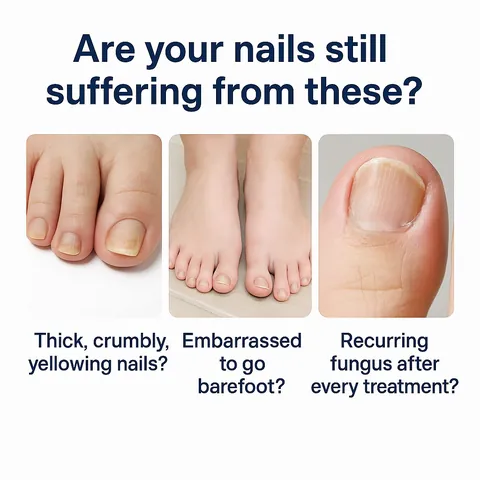 Pluma de Tratamiento para Hongos en las Uñas de los Pies Suero Reparador Antihongos para Uñas Frágiles Engrosadas Descoloridas Esencia para el Cuidado de los Pies