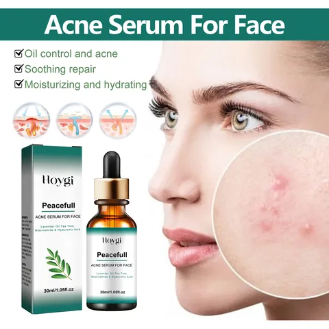 Hoygi Suero para el Tratamiento del Acné Aceite de Árbol de Té Niacinamida Cierre de Poros Esencia Reparadora Cuidado Facial 30ml