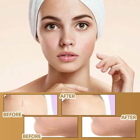 Skin Invisible Concealer Sticker Waterproof Breathable Scar Tattoo Birthmark Cover Up Patches Skin Tone Concealing Sticker
