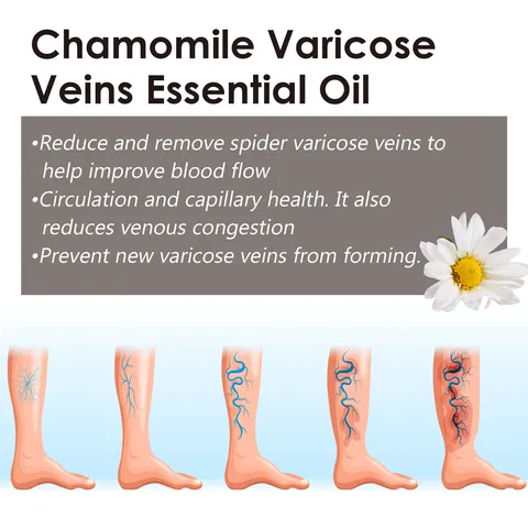 OUHOE Chamomile Leg Massage Essential Oil For Varicose Veins Relief Soothing And Moisturizing Leg Treatment Skin Care Oil