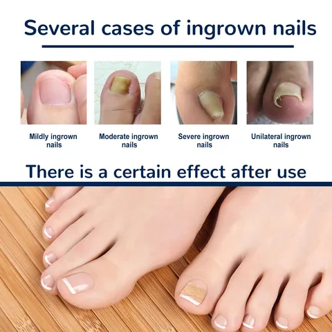 Toenail Correction Patches Ingrown Toenail Treatment Professional Foot Care Nail Repair Tools Nude Elastic Stickers