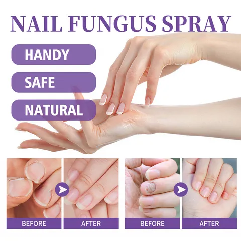 Jaysuing Nail Fungus Spray Foot and Hand Care Anti Fungal Treatment Repair Liquid Soothing Cooling Formula