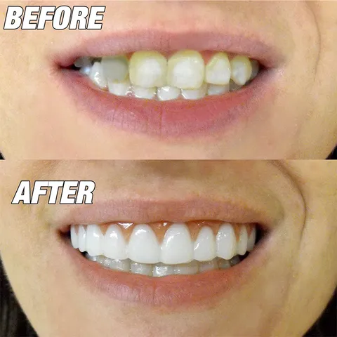 Cosmetic Silicone Fake Teeth Whitening Braces Upper Teeth Veneer Natural Smile Denture Oral Care Tool For Daily Oral Care